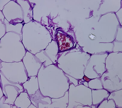 Lipoma, benign growth of fatty tissue, benign neoplasm, adipocytes, partially capsulated tumor, 40x microscopic view.