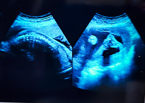 Collage of medical images of ultrasound anomaly scan on a male fetus 25 weeks into the pregnancy, inside womb. Anomaly scan usg.