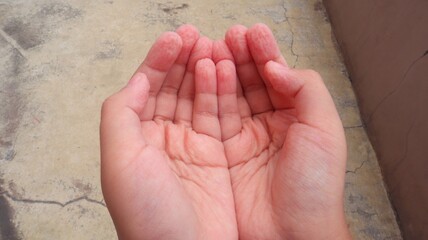 Child's hands are wrinkled after being exposed to water for a long time, close-up view.