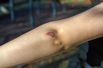 The man has a bruise and abrasion on his arm.