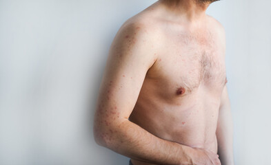 Man with typical measles rash red spots merging together covering face chest and body accompanied by fever