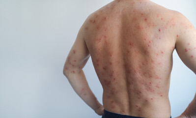 Man with large red plaques and peeling skin on body chronic inflammatory skin disease psoriasis flare up