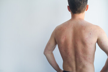 Naklejka premium Man with small red rash after viral infection swollen lymph nodes and elevated body temperature