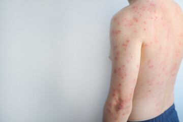 Red rash and blisters cover a man's body showing severe allergic reaction with inflammation and intense itching.
