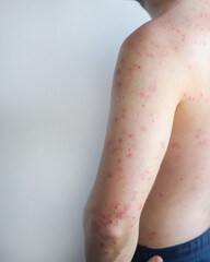 Man with large blisters on torso and arms showing sudden onset of acute hives with redness and...