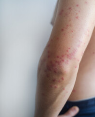 Small red rash spreads across a mans face and body showing gradual merging of spots typical of measles infection.