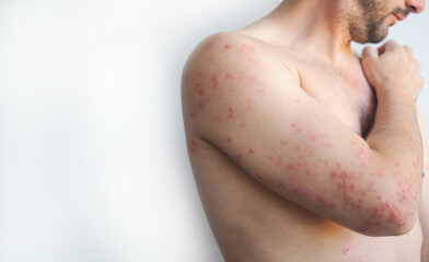 Small blisters and red itchy spots cover a mans body showing typical adult chickenpox symptoms in...