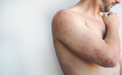 Bright fine rash on a mans chest arms and back with itching showing typical symptoms of scarlet fever in video.