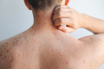 Naklejka premium Man with red itchy rash and ring shaped inflamed spots on body showing signs of fungal skin infection in video.