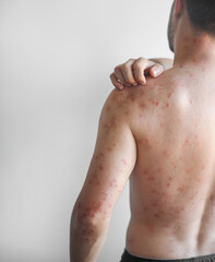 Naklejka premium Red itchy scaly patches on a mans chest back and shoulders showing chronic skin irritation and discomfort in video.