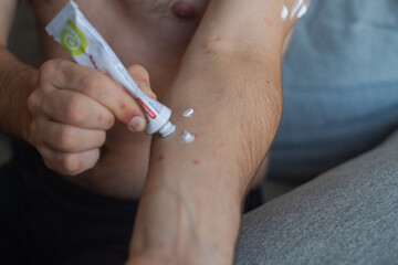 Man with pronounced rash and redness on chest and arms applies medicated cream to relieve itching and skin inflammation.