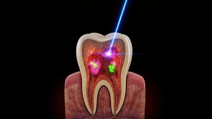 A cross section molar showing inner infection targeted by blue laser therapy, highlighting tooth decay or sensitivity with bright clinical focus