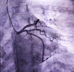Coronary angiogram of left coronary artery during cardiac catheterization with contrast dye. Abnormal findings. Colour adjust.