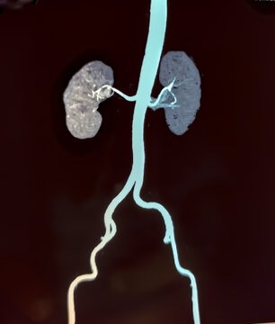 CT scan of KUB with contrast : Left renal small partially exophytic cortical cyst is seen at lower pole. Kidney cyst. Bilateral renal cortical simple cysts.