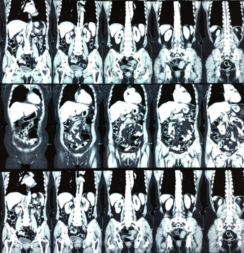 CT scan of KUB with contrast : Left renal small partially exophytic cortical cyst is seen at lower pole. Kidney cyst. Bilateral renal cortical simple cysts.