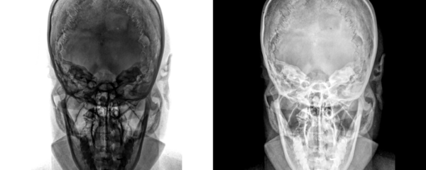 Mastoid Towns Projection X-Ray Image Demonstrating Mastoid Bone Details and Air Cavities for Mastoiditis Detection and Diagnosis, Isolated on Transparent Background