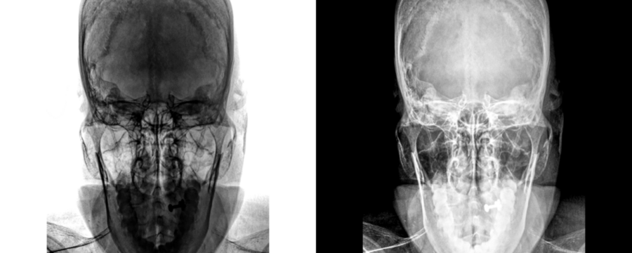 Mastoid Towns View Displaying Mastoid Air Cell Patterns and Bone Structures for Diagnosis of Mastoiditis and Ear-Related Conditions Isolated on Transparent Background - Powered by Adobe