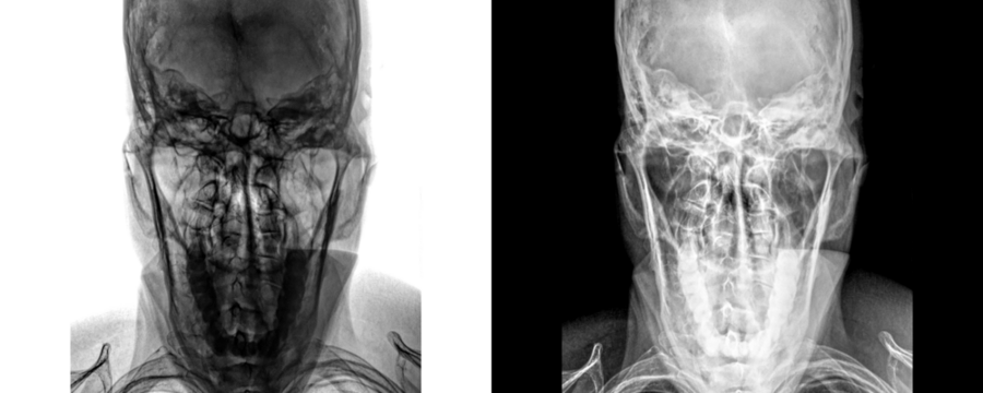 Mastoid Towns View X-Ray Radiograph Depicting Mastoid Bone Anatomy and Air Cell Structure for Detection of Infections and Isolated on Transparent Background
