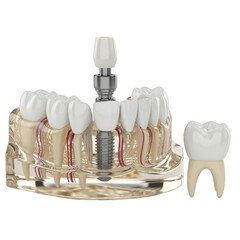 Detailed dental implant model showing tooth replacement and bone structure isolated on transparent background