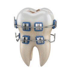 Realistic dental tooth model with blue braces and archwire isolated on transparent background