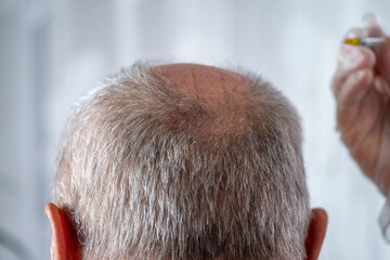 Mature bald man receiving hair restoration therapy specialized clinic, Male patient undergoing trichology treatment for androgenetic alopecia, Professional medical approach hair loss in men using