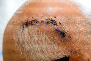 Elderly Man's Head with a Fresh Surgical Wound, Blue Sutures, and Staples on the Scalp After a Cranial Operation or Injury Treatment
