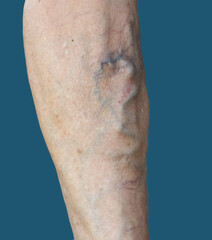 The leg of a person with a visible vein.