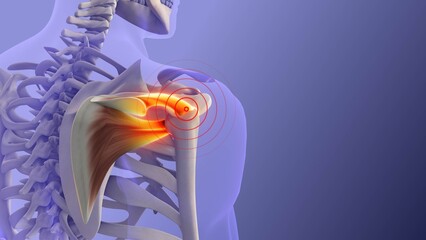 Anatomical View of Painful Rotator Cuff Muscles