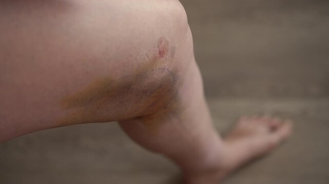 Close-up of female patient leg showing large bruise, swelling, and discoloration from liposuction treatment, with person gently touching affected area during recovery process. Shooting in slow motion.
