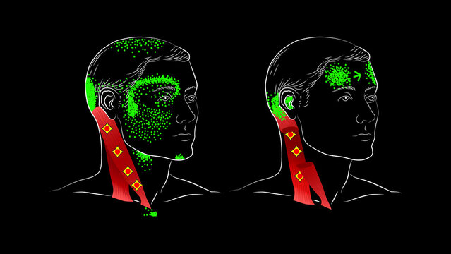 Sternocleidomastoid muscle. Trigger points, referred pain