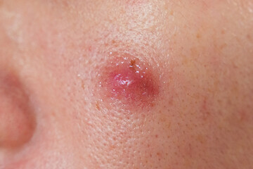 Fototapeta premium Asian man with inflamed acne and dark scar on cheek