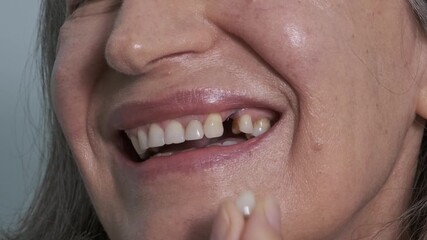 Loss of a dental implant. A woman's mouth with a missing dental crown that broke off from the implant. Metal remains are visible. Concept of the reliability and longevity of implants.