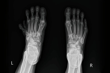 Bilateral feet X-ray radiograph showing polydactyly with extra digits, metatarsal bones, phalanges, and tarsal anatomy. Medical diagnostic imaging for congenital anomaly evaluation, orthopedic exam.
