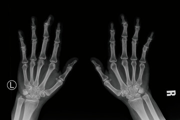 Bilateral hands X-ray radiograph showing finger bones, phalanges, metacarpals, carpal bones, and wrist skeletal anatomy. Medical diagnostic imaging for orthopedic evaluation, bone age assessment, and 