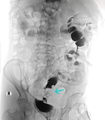Xray imaging of colon carcinoma barium enema contrast study