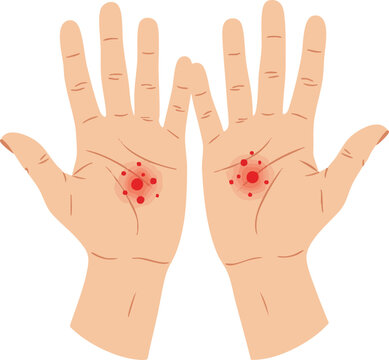 Flat medical illustration showing symmetrical palmar erythema with red spots on both palms, useful for educational, dermatology, or health awareness content