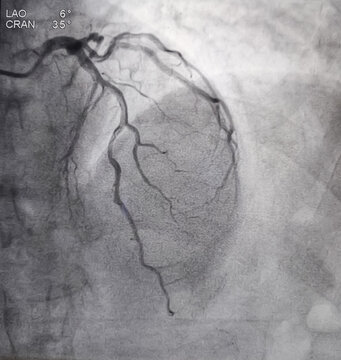 Coronary angiogram of left coronary artery during cardiac catheterization with contrast dye. Abnormal findings. Colour adjust
