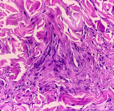 Left forearm skin tissue sample, Xanthoma. Microscopically show skin and dermis show foamy histiocytes. Yellow lesions caused by lipid accumulation in foam cells in the skin.