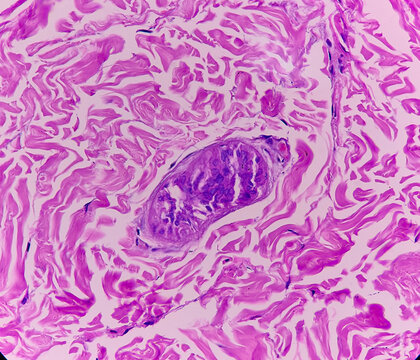 Left forearm skin tissue sample, Xanthoma. Microscopically show skin and dermis show foamy histiocytes. Yellow lesions caused by lipid accumulation in foam cells in the skin.