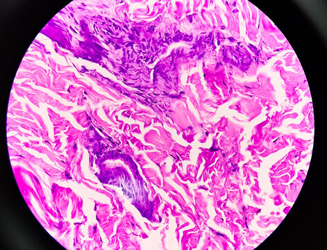 Left forearm skin tissue sample, Xanthoma. Microscopically show skin and dermis show foamy histiocytes. Yellow lesions caused by lipid accumulation in foam cells in the skin.