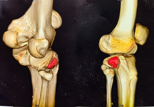 CT Scan of Knee joint 3D rendering Showing fracture of Patella, tibia.