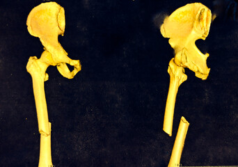 CT Scan of pelvic bones with both hip joint 3D rendering image isolated on black background....