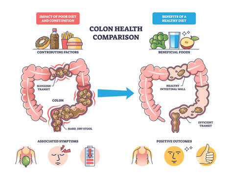 Colon health comparison illustrating diet effects, two colon diagrams show constipation vs efficient transit, arrow transition, key objects, colon, arrow, foods, transparent background.