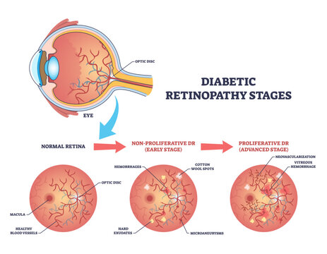 Diabetic retinopathy stages diagram shows retina, optic disc, and blood vessels, illustrating normal to non proliferative to proliferative progression for patient education, transparent background.