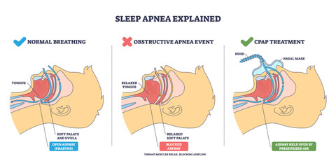 Normal breathing overview shows airflow, tongue and soft palate shape open vs blocked airway, transparent background.CPAP holds airway open.Key objects, airway, tongue, nasal mask.
