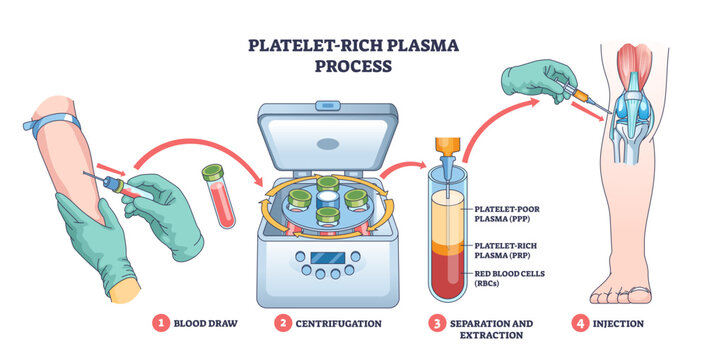 Platelet-rich plasma process shows blood draw, centrifuge separation, and PRP injection into the knee for healing, key objects, syringe, centrifuge, knee joint, transparent background.