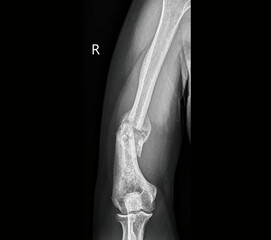 Lateral elbow X-ray radiograph showing distal humerus, radius, ulna, and elbow joint anatomy in...