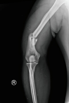 Lateral arm X-ray radiograph showing fracture humeral shaft anatomy. Medical diagnostic imaging for orthopedic evaluation, fracture detection after accident in emergency department.