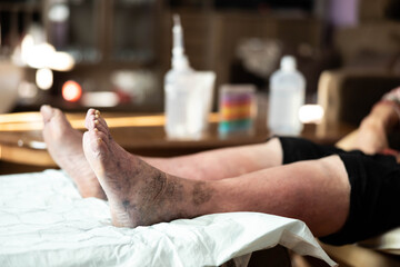 An intimate close-up view of a person's feet and legs, showcasing the texture of the skin and details of discoloration, inviting contemplation on age and health conditions.