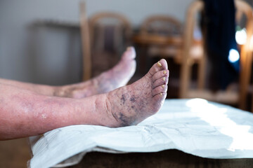 The image showcases the feet of an elderly person, highlighting prominent discoloration, indicating possible health issues and the effects of aging on the skin and circulation.